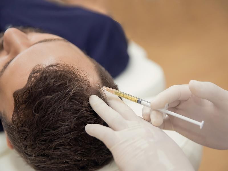 PRP Capilar: Como Funciona o Tratamento com Plasma Rico em Plaquetas?