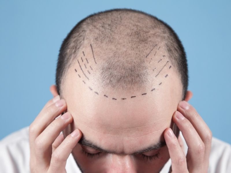 Planejamento da linha frontal no transplante capilar: como funciona