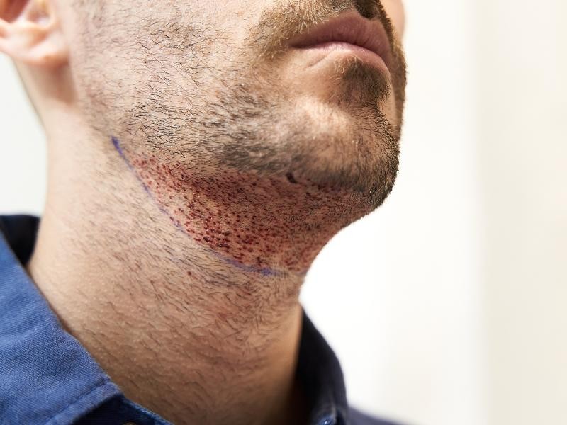 Transplante de Barba: Como Funciona e Para Quem é Indicado?