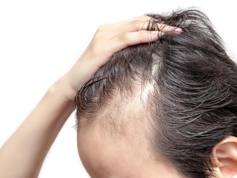 Tratamento Alopecia Androgenética